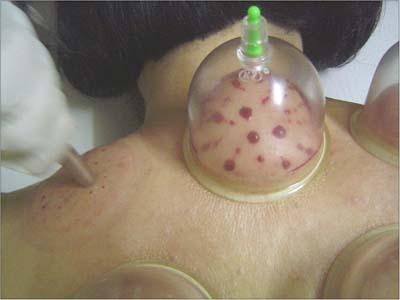 wetcupping